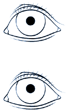 Glaucoma illustration